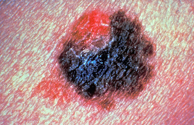 Researchers Uncover Immune Environment of Rare Type of Melanoma