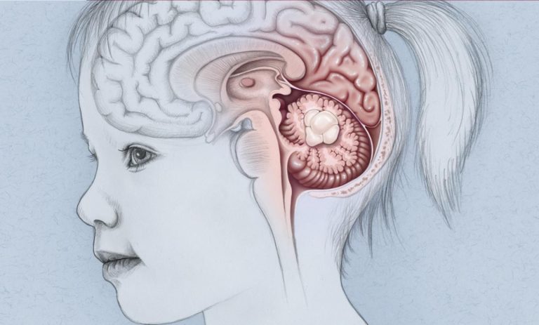 Origin of Childhood Brain Tumors Discovered
