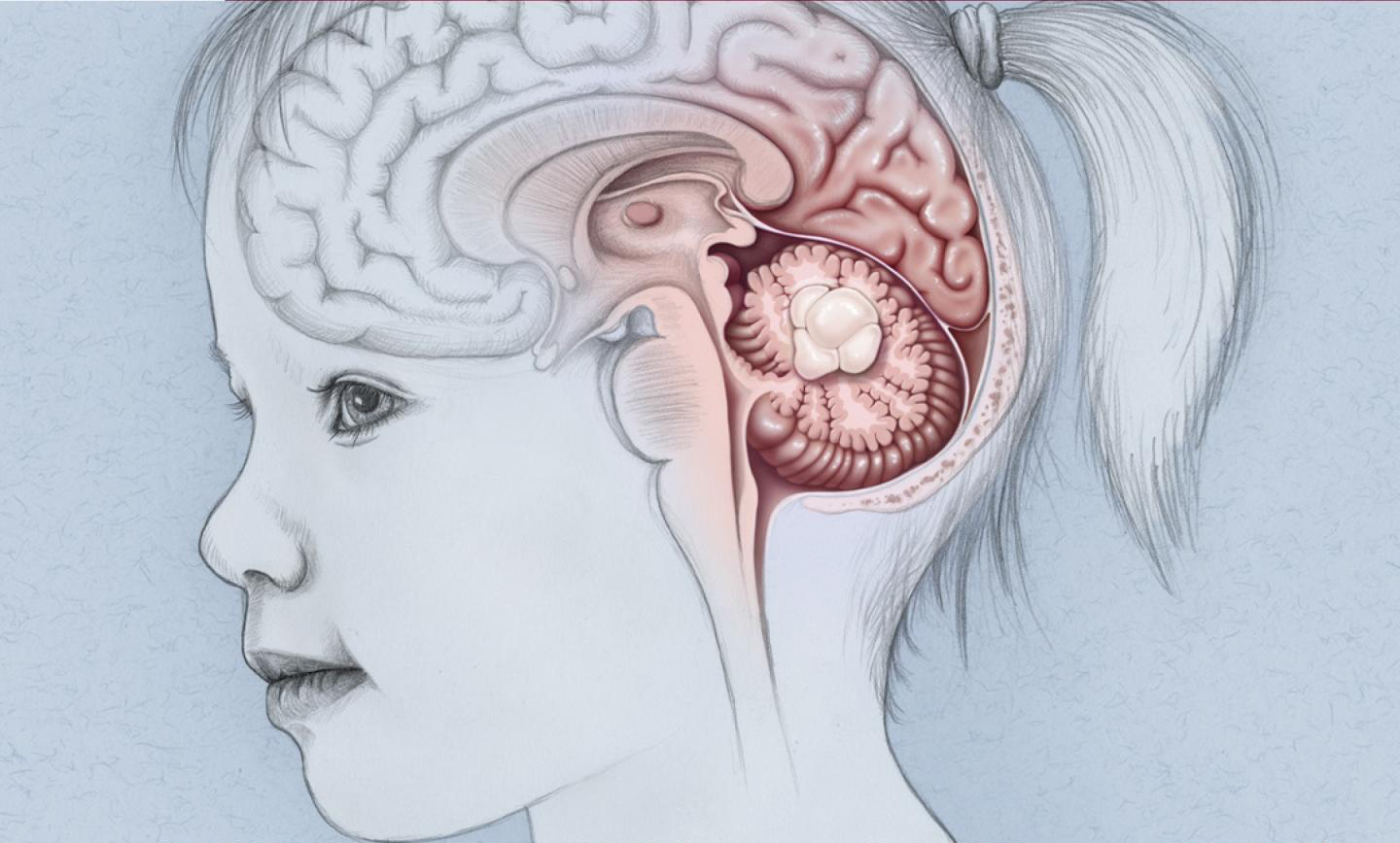 Pediatric Brain Tumors Shrink From Epigenome Targeted Therapy