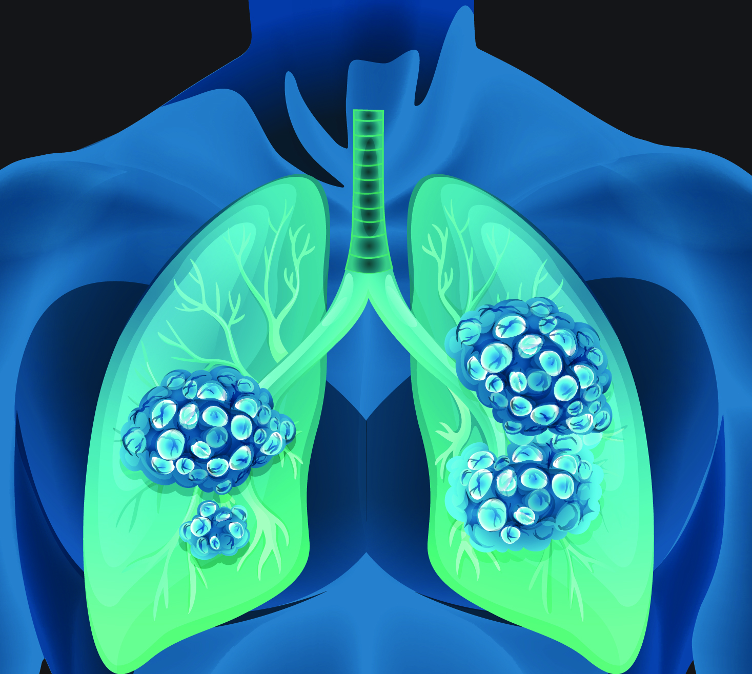 New nanoparticles can perform gene editing in the lungs, MIT News