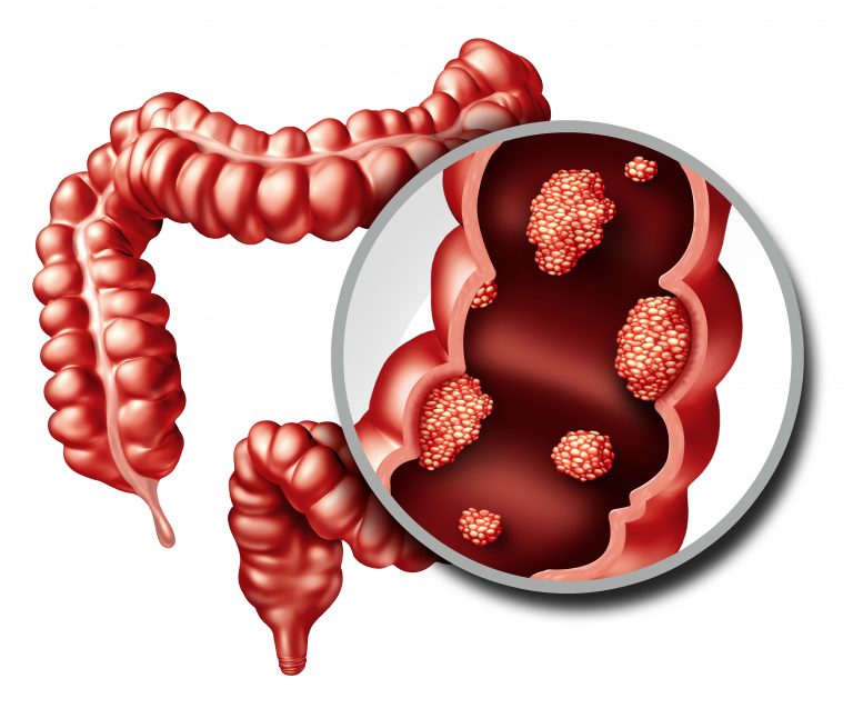 Colorectal Tumors May Be Boosted by Cholesterol Production