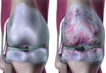 Blood-Based Biomarker Warns of Arthritic Knees Years in Advance
