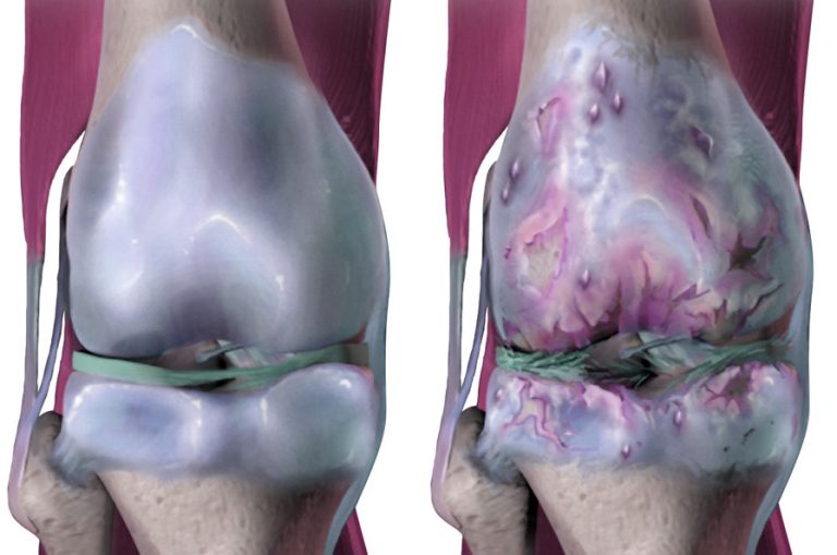 Blood-Based Biomarker Warns of Arthritic Knees Years in Advance