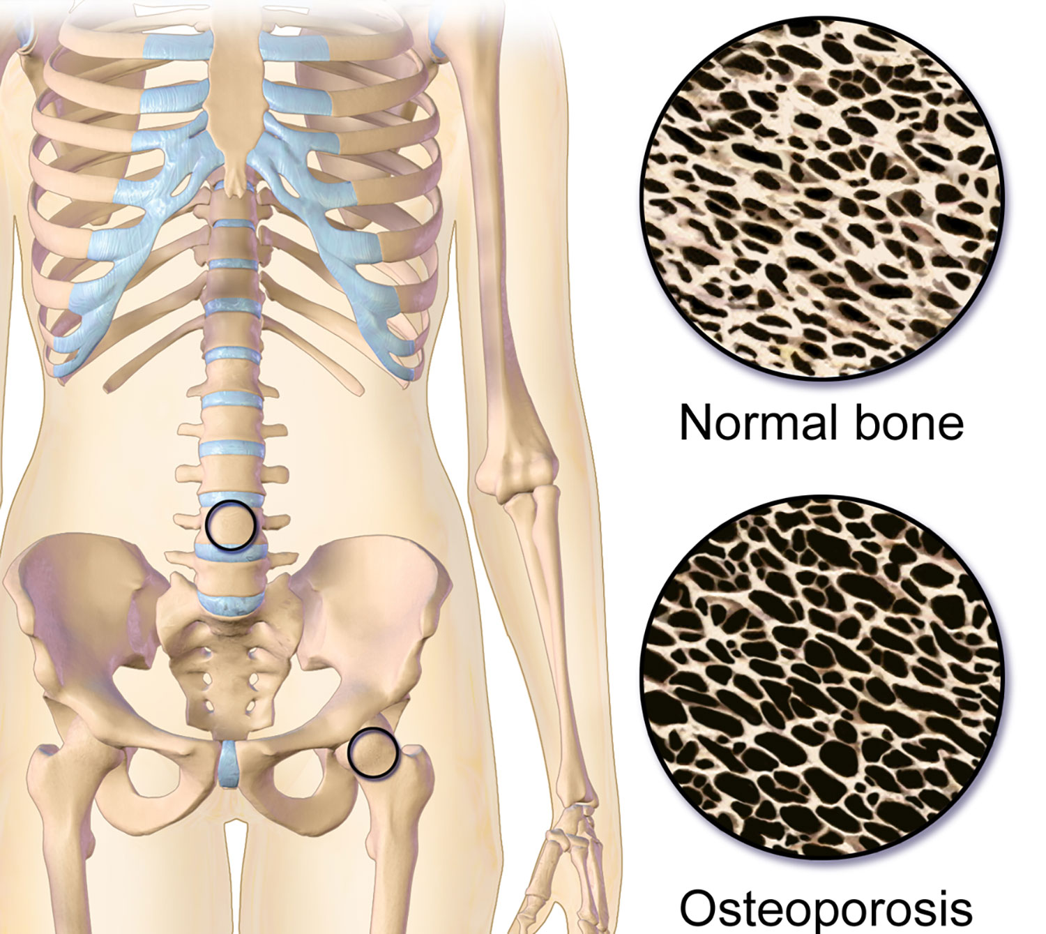 Ilustración que muestra el cambio de estructura ósea debido al padecimiento de osteoporosis