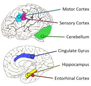 map of human Alzheimer’s brain