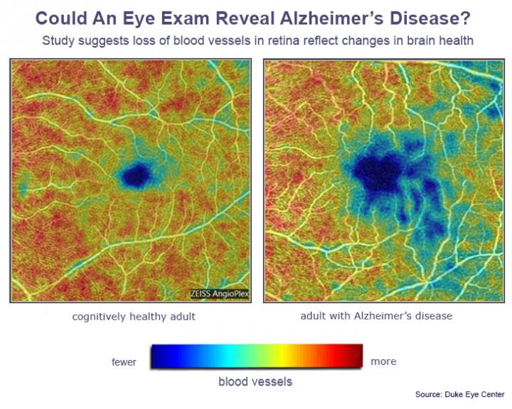 Alzheimer’s Disease Signs Detected by Noninvasive Eye Scan