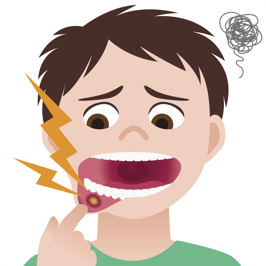 stomatitis, mouth ulcer, inflammation of the oral mucosa, image illustration