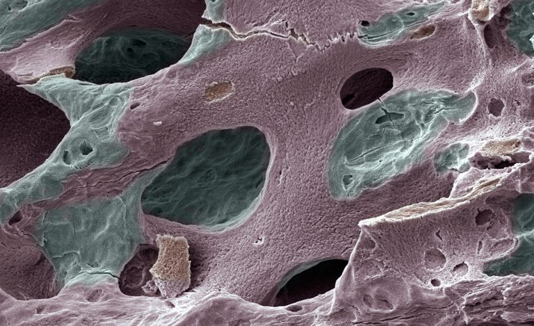 Antimalarial Drug Reverses Bone Loss in Mouse Model of Ostoporosis