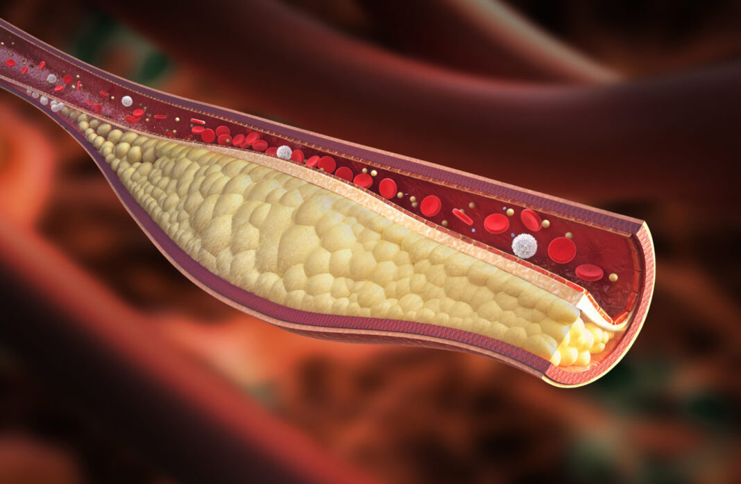 Vein Atherosclerotic Plaque