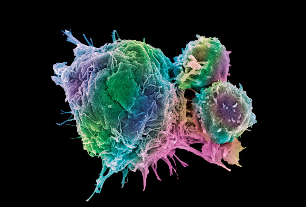 Cancer cell and T lymphocytes, SEM