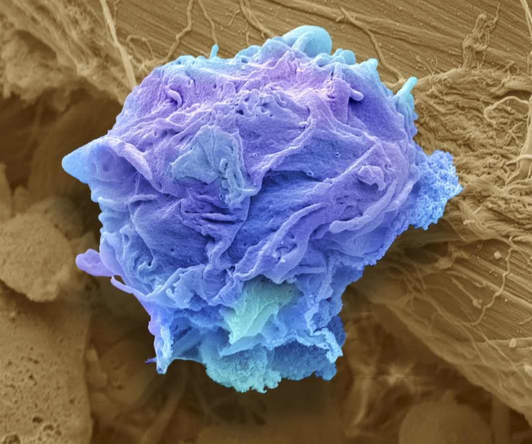 Lymphoma cancer cell, SEM