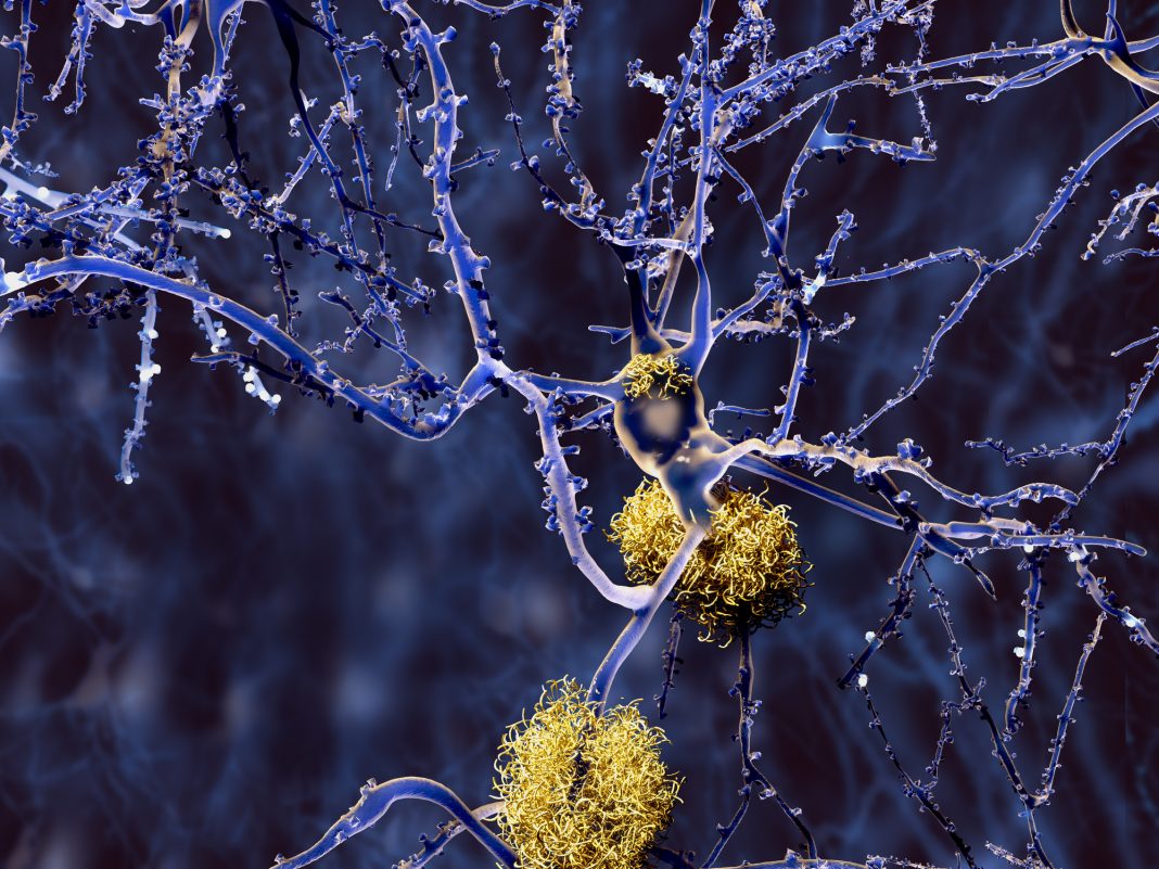 Alzheimer disease, neurons with amyloid plaques