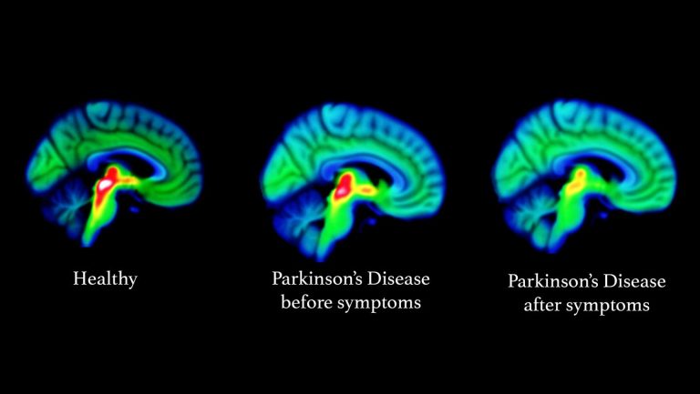 Parkinson’s Disease Brain Malfunction Evident in Scans Potentially Years Before Symptoms