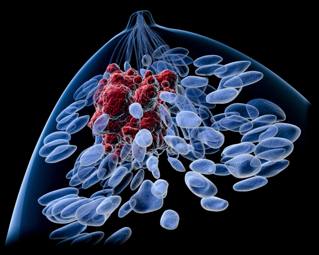 Breast cancer