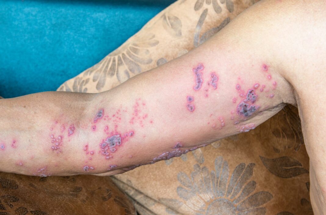 Detail of right arm skin with Herpes Zoster (Shingles) on man's arm.