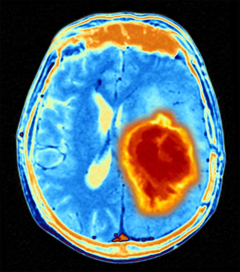 Cerebrospinal Fluid May Play a Role in Brain Cancer Treatment Resistance