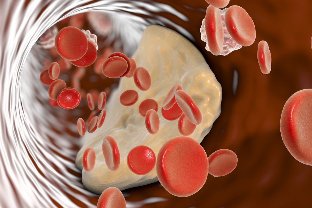 Atheromatous plaque, illustration