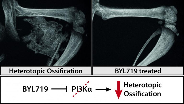 PI3-kinase Inhibitor Opens New Pathways for Treating Two Bone Diseases