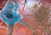 Alzheimer’s Disease Neurons Reenter Cell Cycle, Become Senescent
