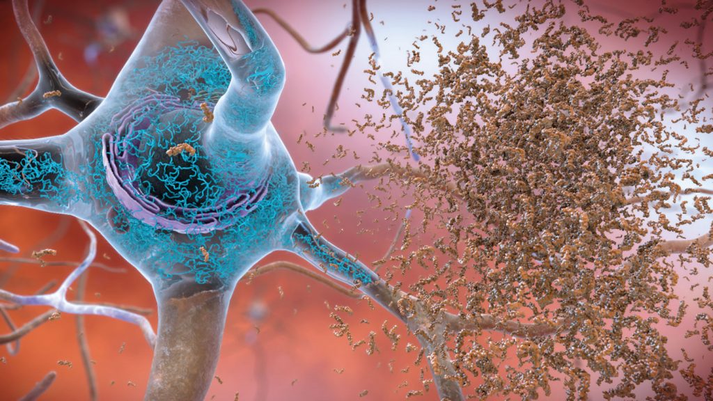 Alzheimer's disease