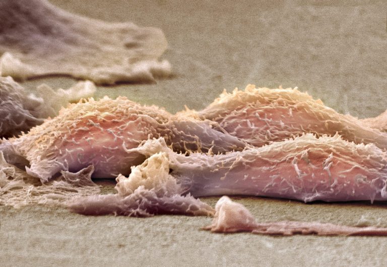 Cancer Cells Turn into Muscle Cells, Potentially Enabling Differentiation Therapy