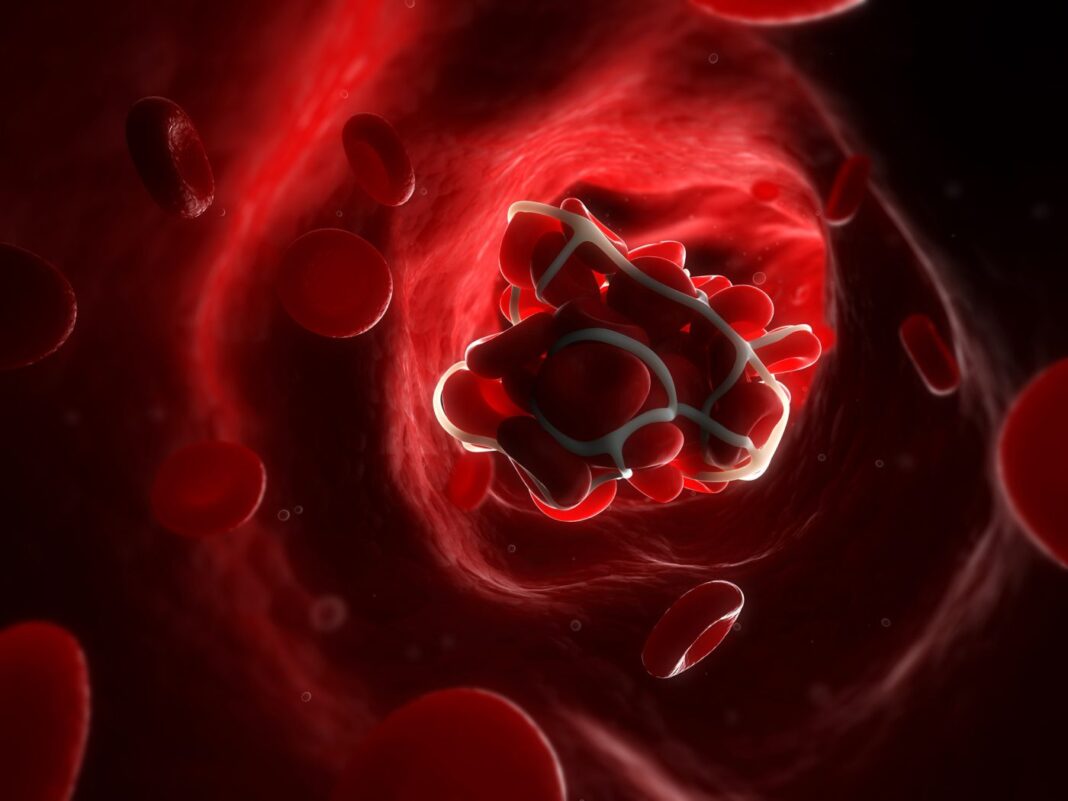 Blood clot, artwork