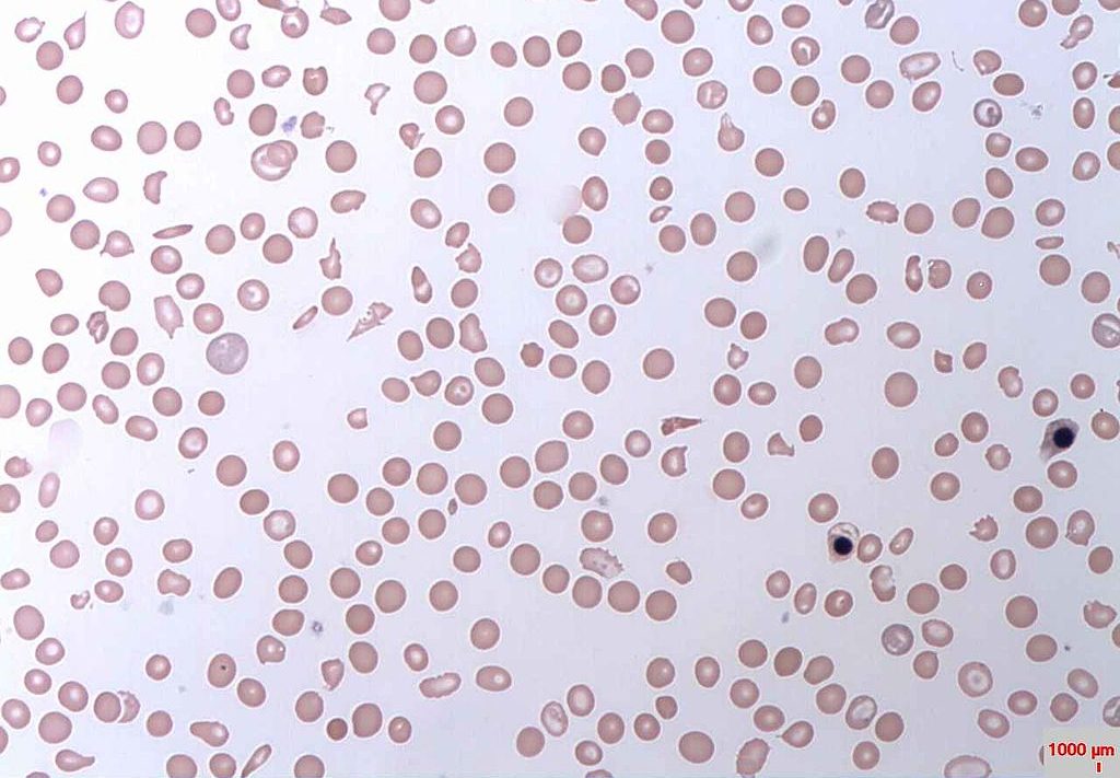 Haemolytic Anaemia