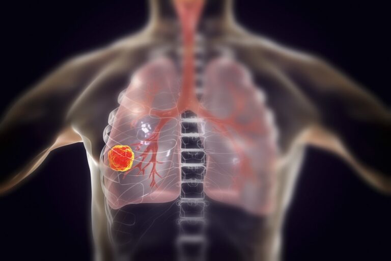 New Therapeutic Target Acquired in Lung Cancer Resistance