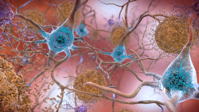 In Alzheimer’s, Inflammasome Drives Both Amyloid and Tau Pathology