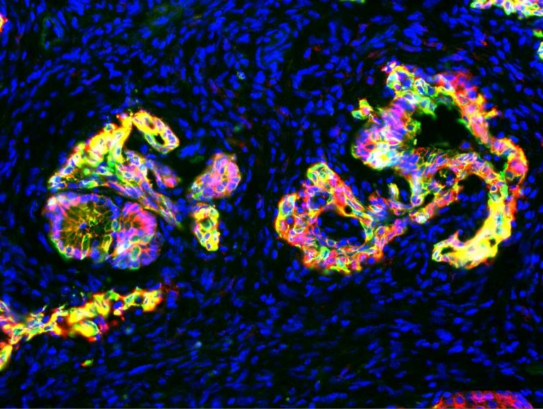 RAS Activation Prevents Pancreatic Cancer Cells from Starving