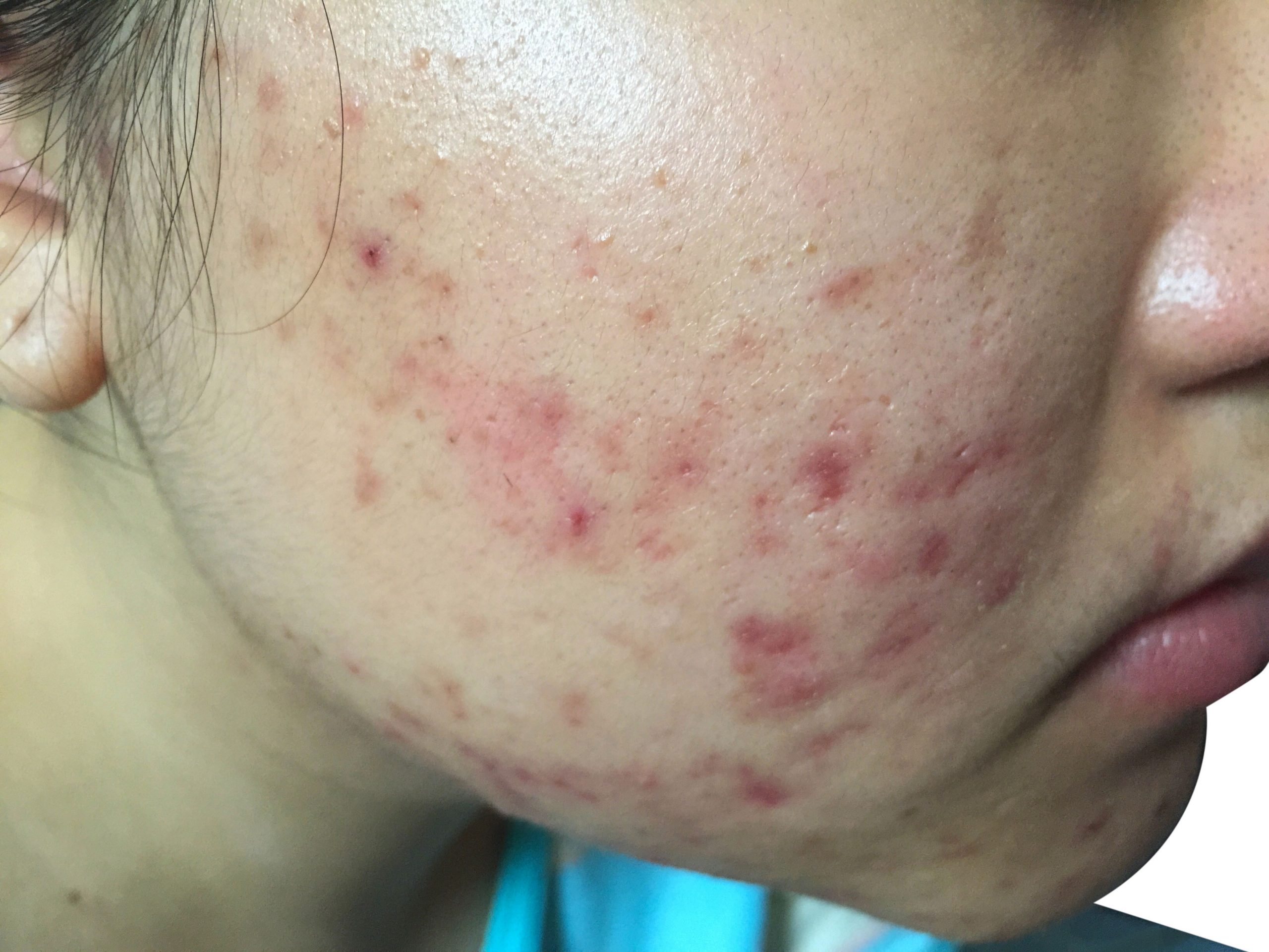 Using Viral Proteins against Bacteria That Cause Acne