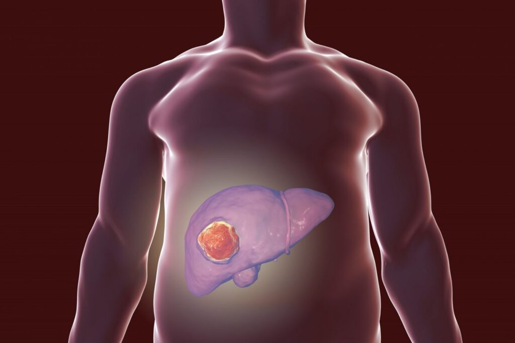 Liver Cancer