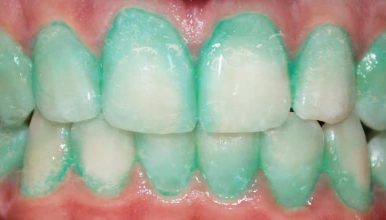 Plaque-Identifying Toothpaste Associated with Significant Reduction in High Sensitivity C-Reactive Protein