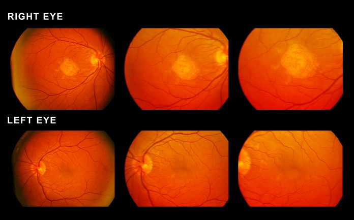 Scan of eyes showing macular degeneration