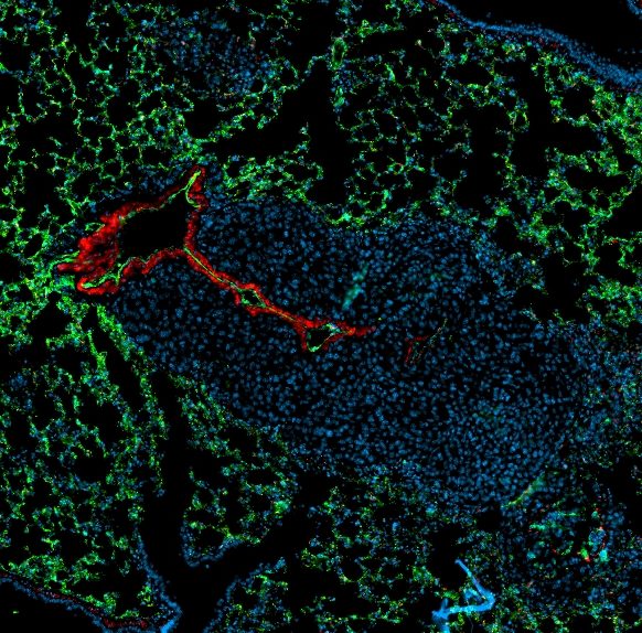 Metastasis Blocking Antibody Shows Preclinical Promise