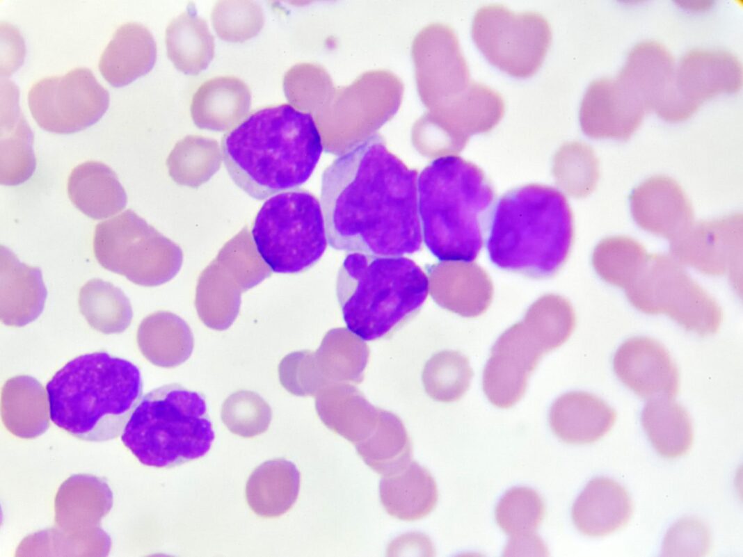 Acute myeloid leukemia (AML)