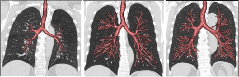 Early Lung Development Linked to COPD Susceptibility among Smokers and Non-Smokers