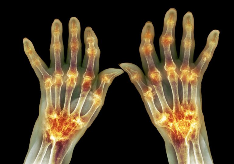 Rheumatoid Arthritis Prediction Improved by New Biomarkers