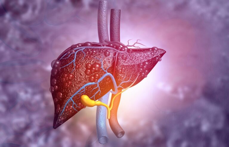 Inflammation in the Liver Reversed by Metformin