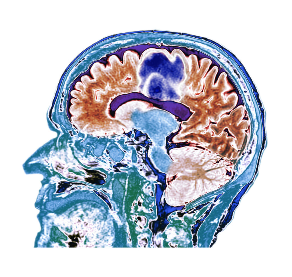 Glioblastoma brain cancer, CT scan