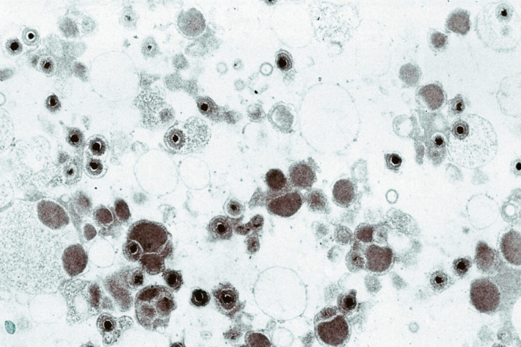 Electron microscope image of cytomegalovirus
