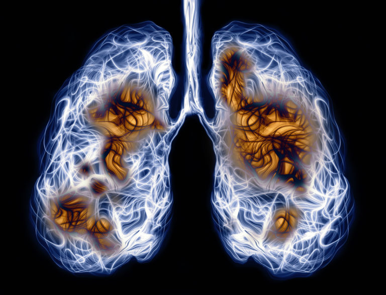 COVID-19- and Flu-Ravaged Lungs Could Be Repaired with mRNA Therapy