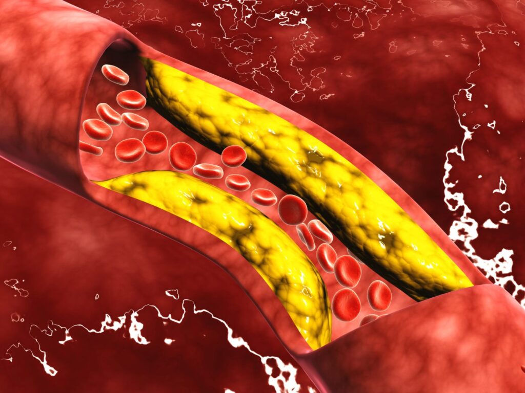 Microscopic view of fat plaque inside the artery.
