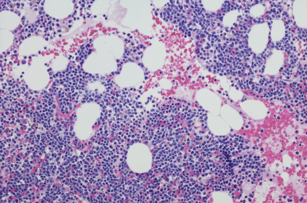 Micrograph of myeloma neoplasm from bone marrow biopsy