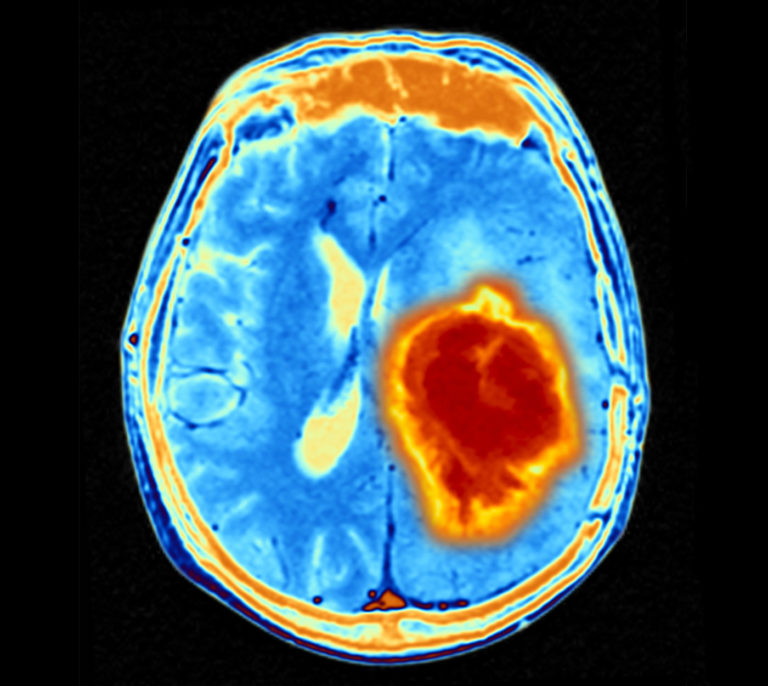 Glioblastoma Linked with Brain Healing after Trauma