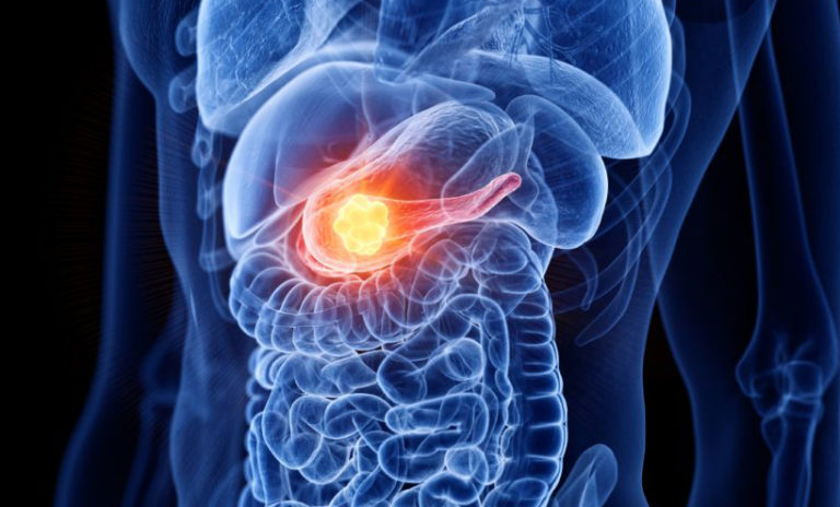 Zeroing In on Earliest Stages of Pancreatic Cancer Development