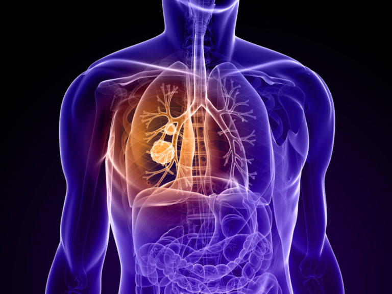 Translate Bio Continues Trial of Inhaled Cystic Fibrosis mRNA Despite Setback