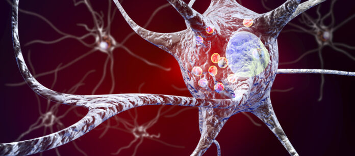 Nautilus, Weill Cornell Team Up to Apply Single Molecule Proteomics Tech to Parkinson’s