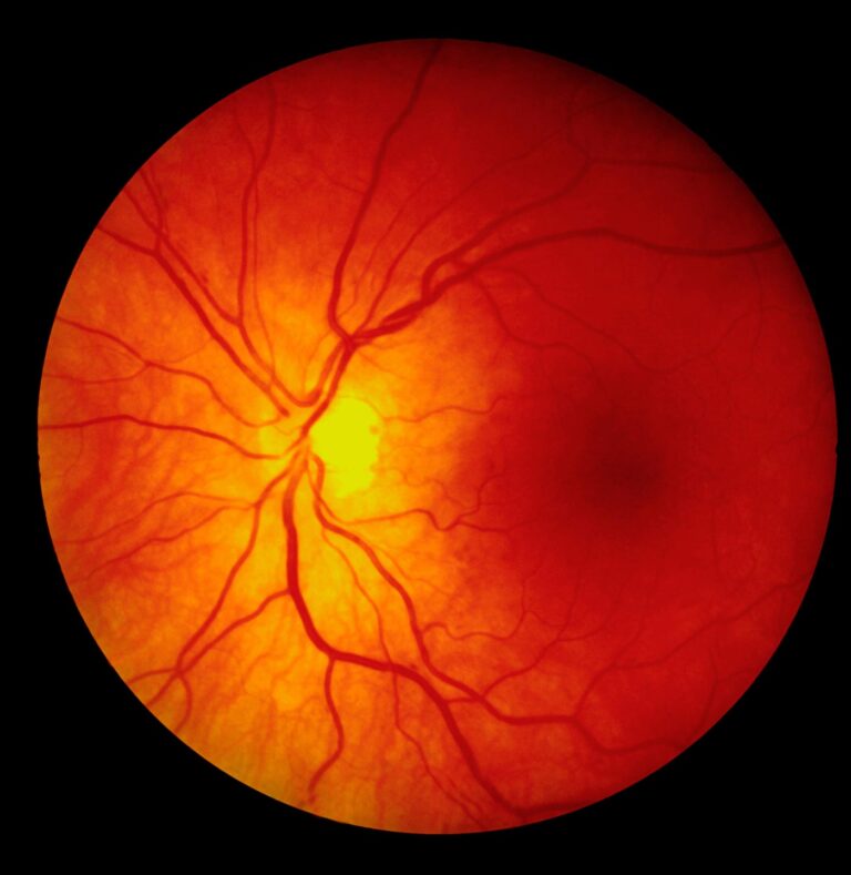 Adverum Confirms Patient Loses Sight in Eye Treated with Its Gene Therapy