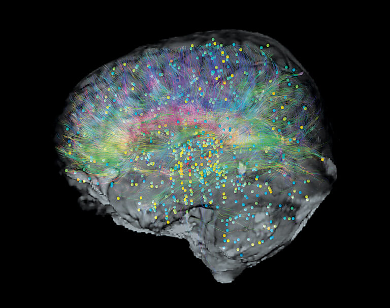 Brain Maps May Reveal the Origins and Paths of Neurological Dysfunction